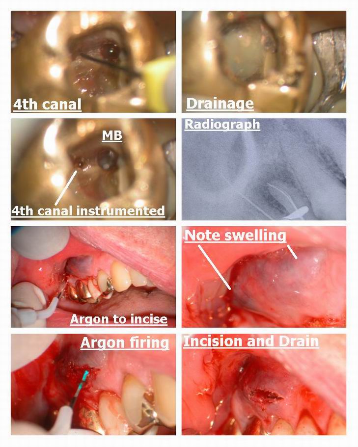 Resize of Incision and drain retreat pg 2.jpg
